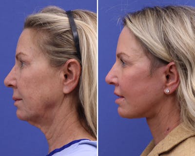 Facelift Before & After Gallery - Patient 402713 - Image 1