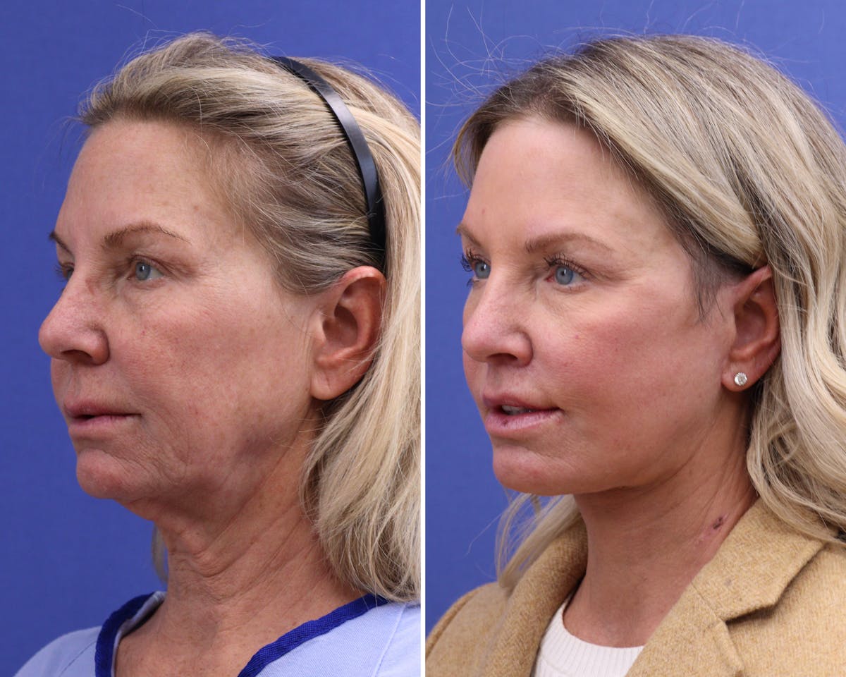 CO2 Laser Resurfacing Before & After Gallery - Patient 370915 - Image 2