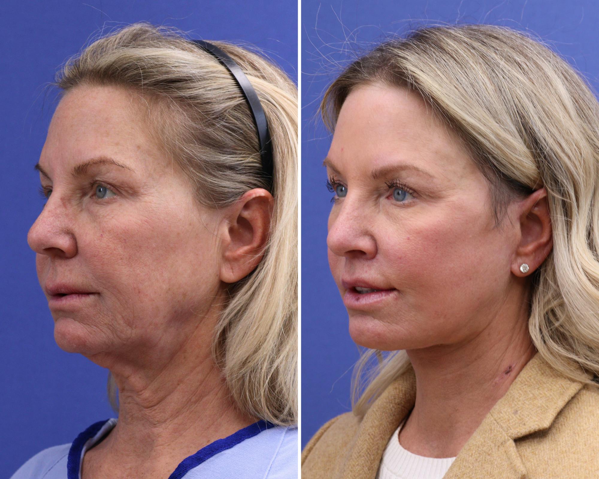 CO2 Laser Resurfacing Before & After Gallery - Patient 370915 - Image 2