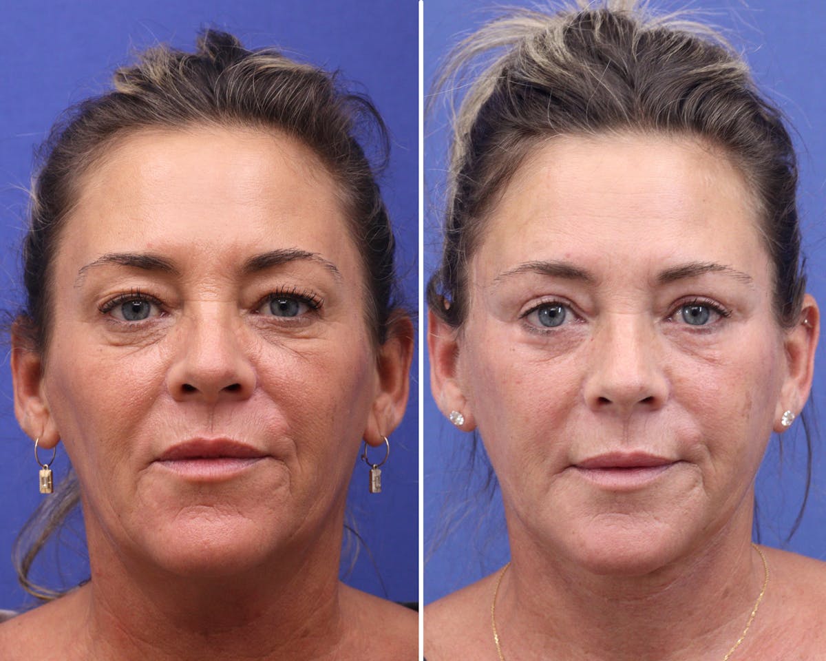 Facelift Before & After Gallery - Patient 340808 - Image 1