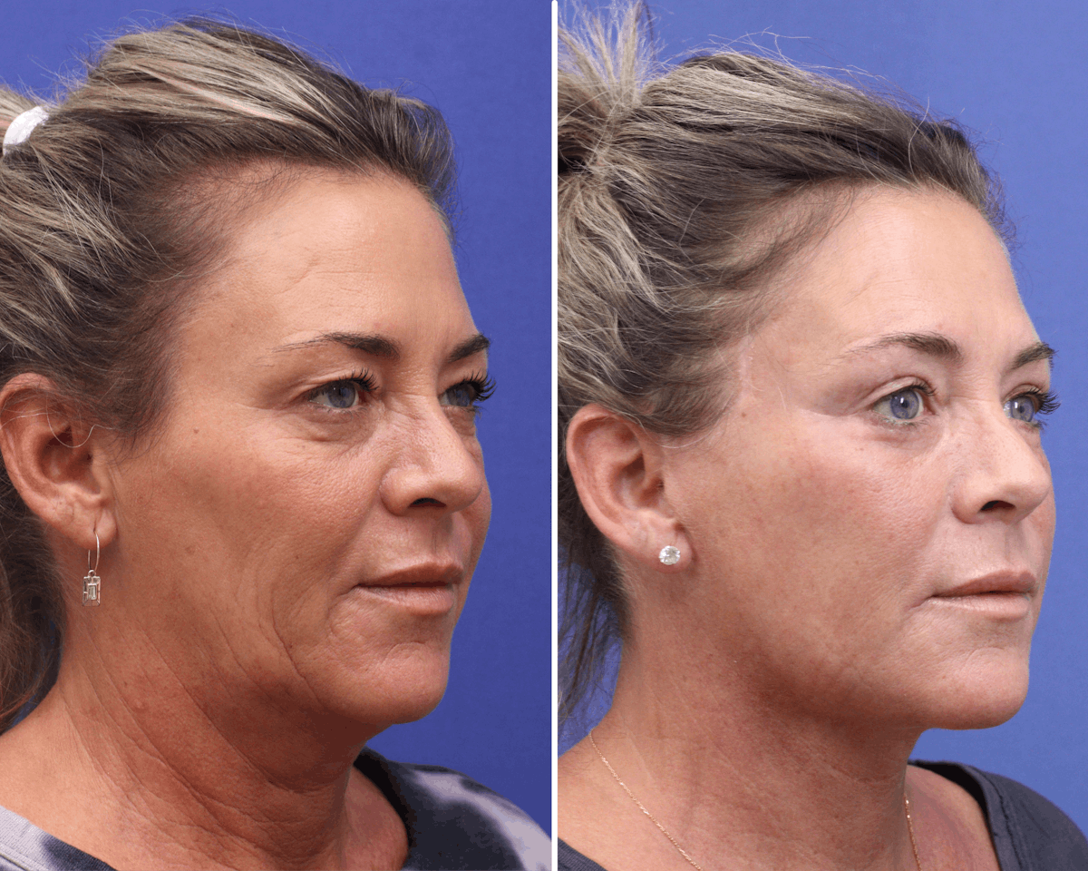 Facelift Before & After Gallery - Patient 340808 - Image 2