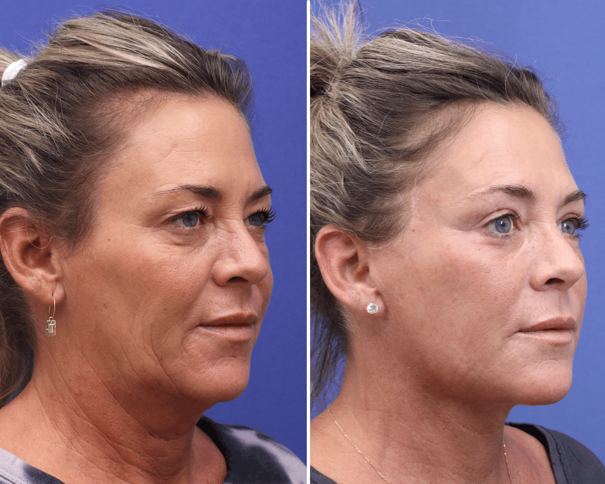Blepharoplasty Before & After Gallery - Patient 946672 - Image 2