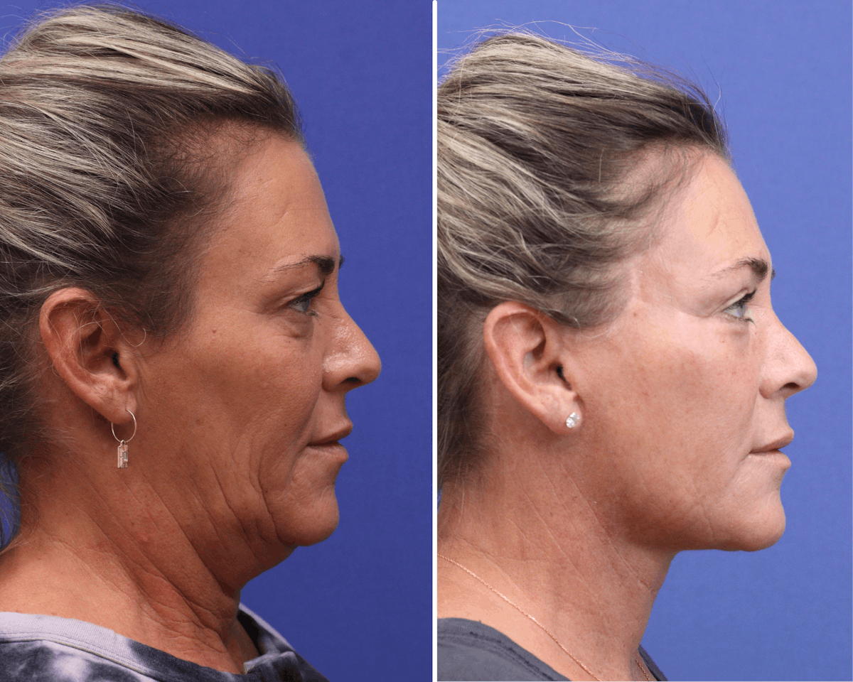 Facelift Before & After Gallery - Patient 340808 - Image 3