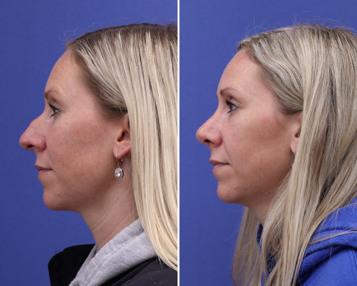 Rhinoplasty Before & After Gallery - Patient 224204 - Image 1