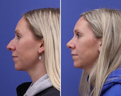 Rhinoplasty Before & After Gallery - Patient 224204 - Image 1