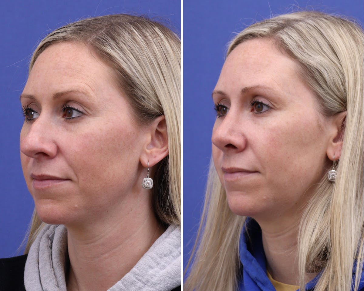 Rhinoplasty Before & After Gallery - Patient 224204 - Image 2
