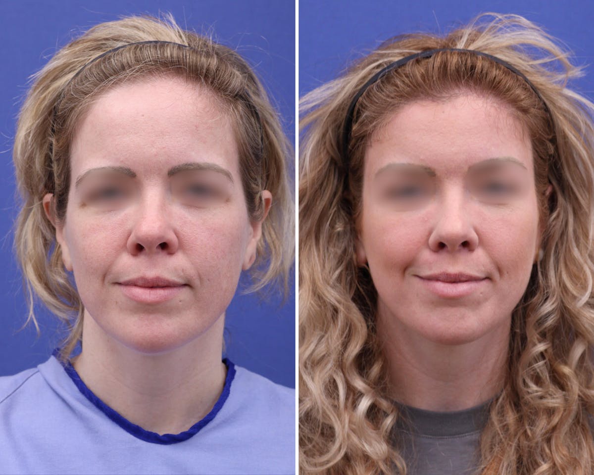 Brow Lift Before & After Gallery - Patient 325205 - Image 1
