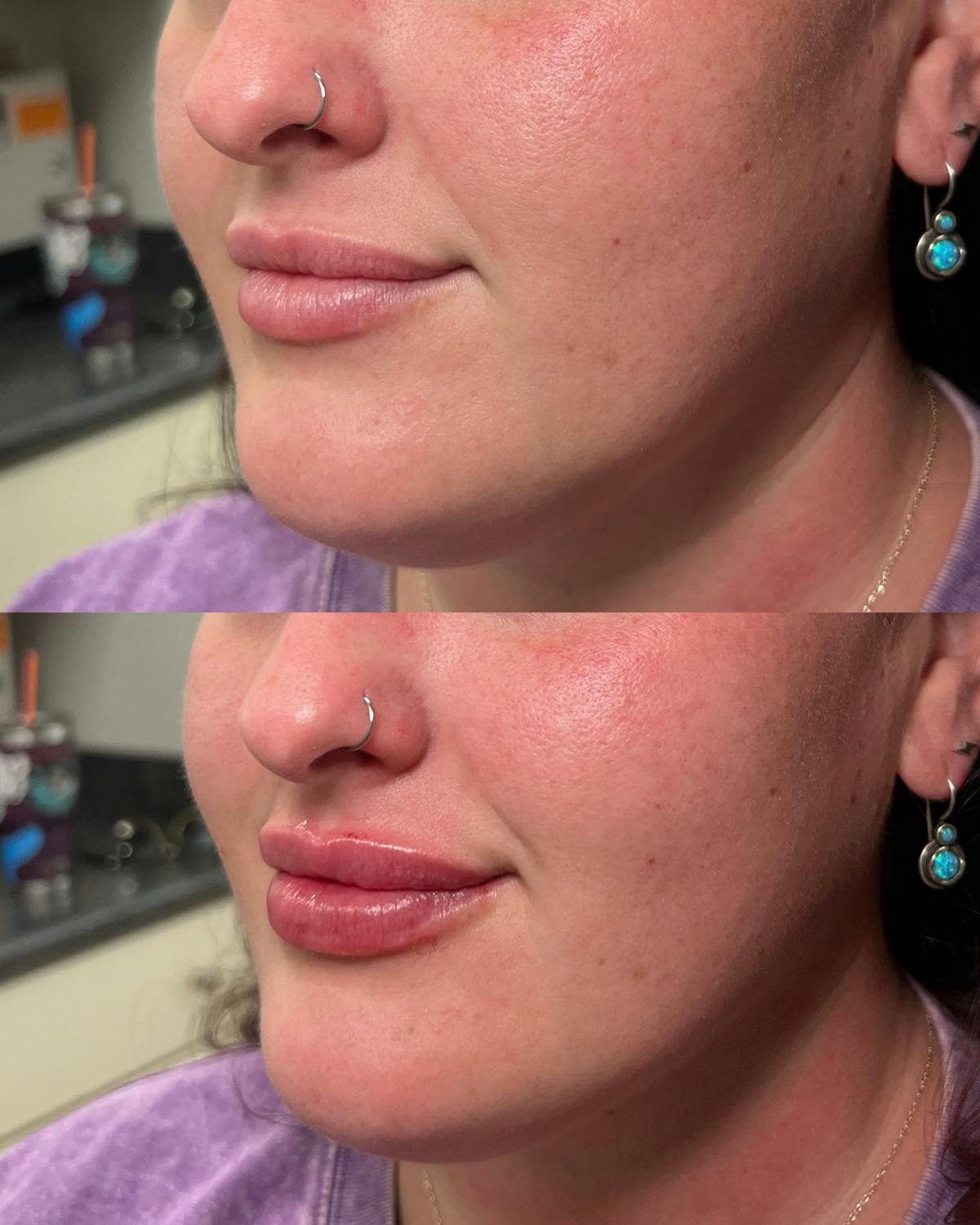 Lip Filler Before & After Gallery - Patient 204969 - Image 1