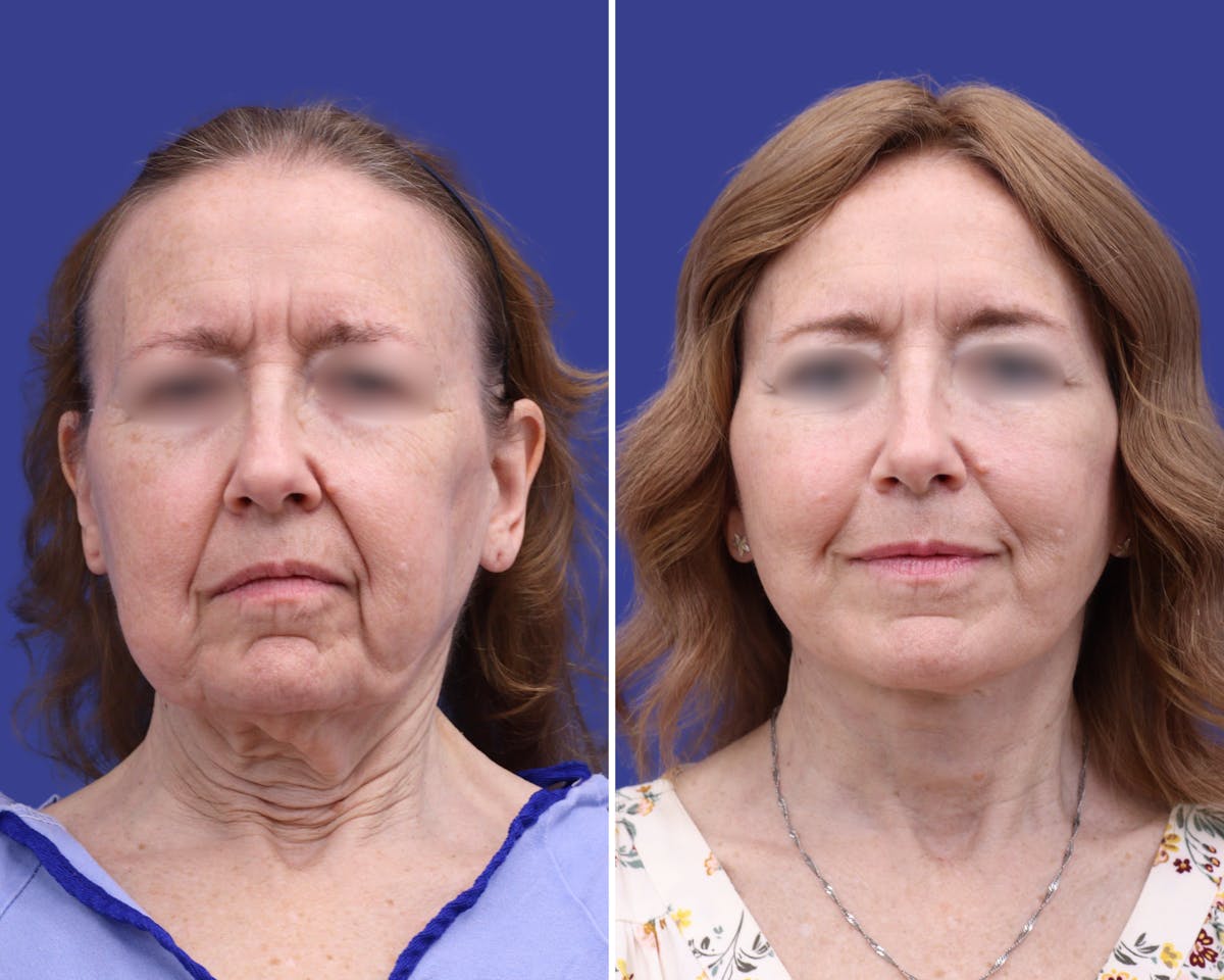 Facelift Before & After Gallery - Patient 398615 - Image 1