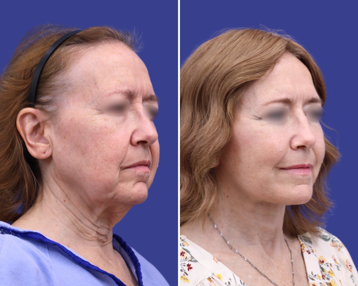 Facelift Before & After Gallery - Patient 398615 - Image 2