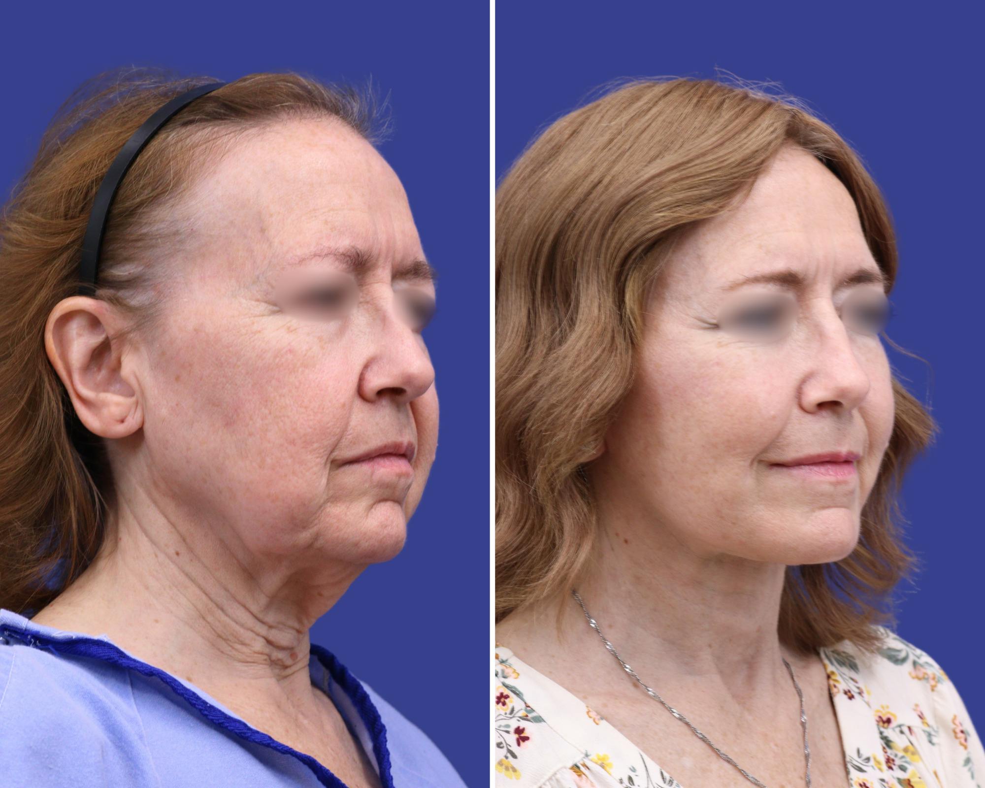 Neck Lift Before & After Gallery - Patient 402440 - Image 1