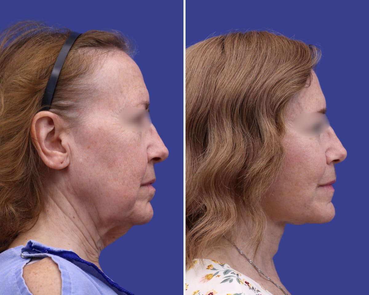 Facelift Before & After Gallery - Patient 398615 - Image 3