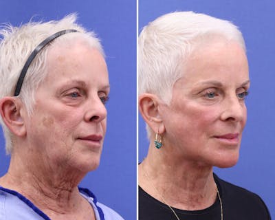 Face Before & After Gallery - Patient 269026 - Image 1