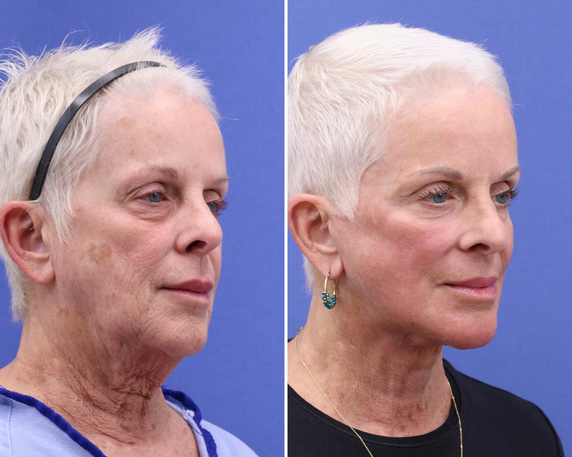 Blepharoplasty Before & After Gallery - Patient 806942 - Image 1
