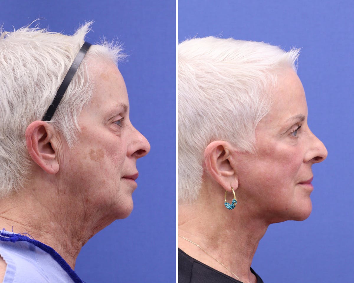 Face Before & After Gallery - Patient 269026 - Image 2
