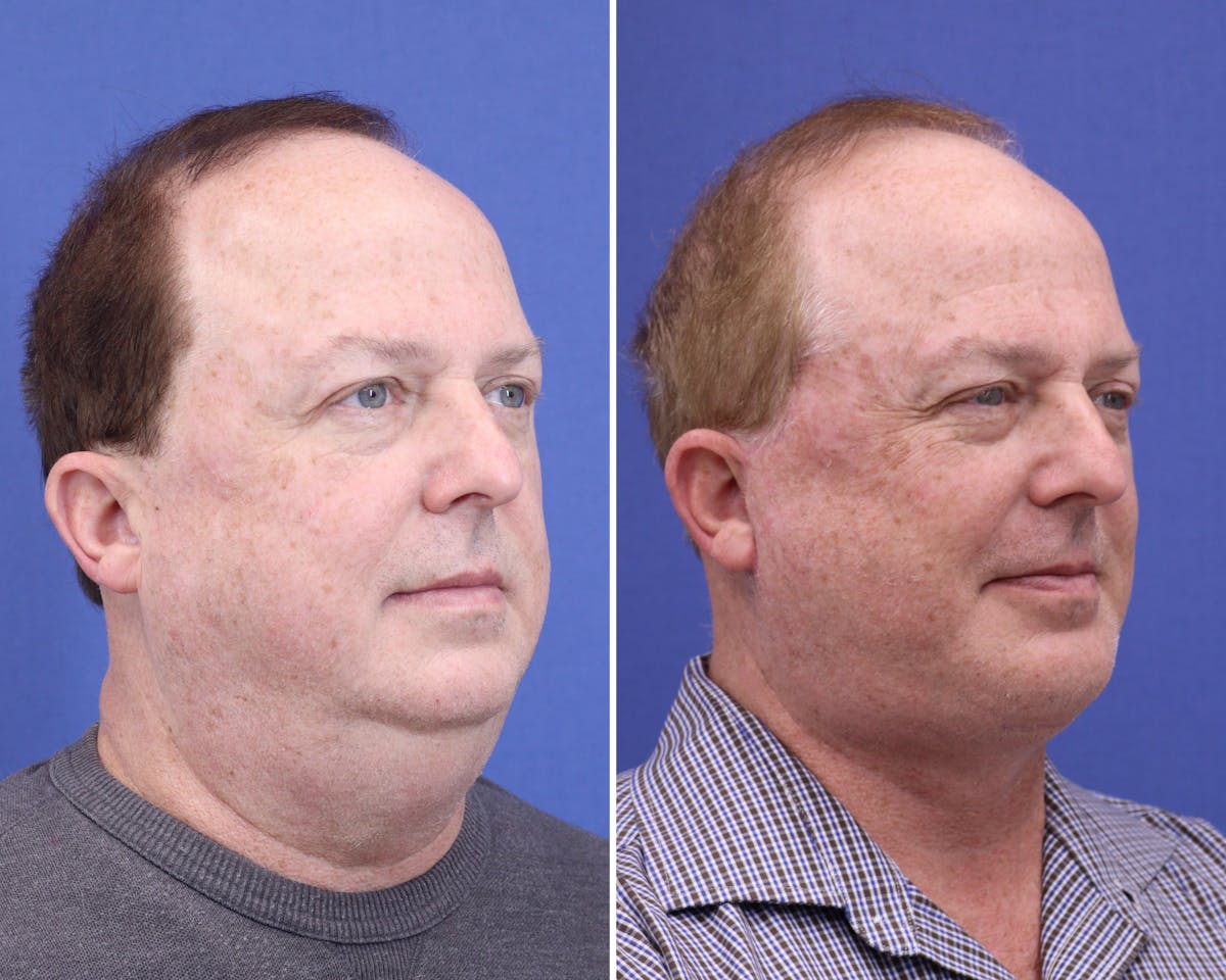 Buccal Fat Removal Before & After Gallery - Patient 224397 - Image 2