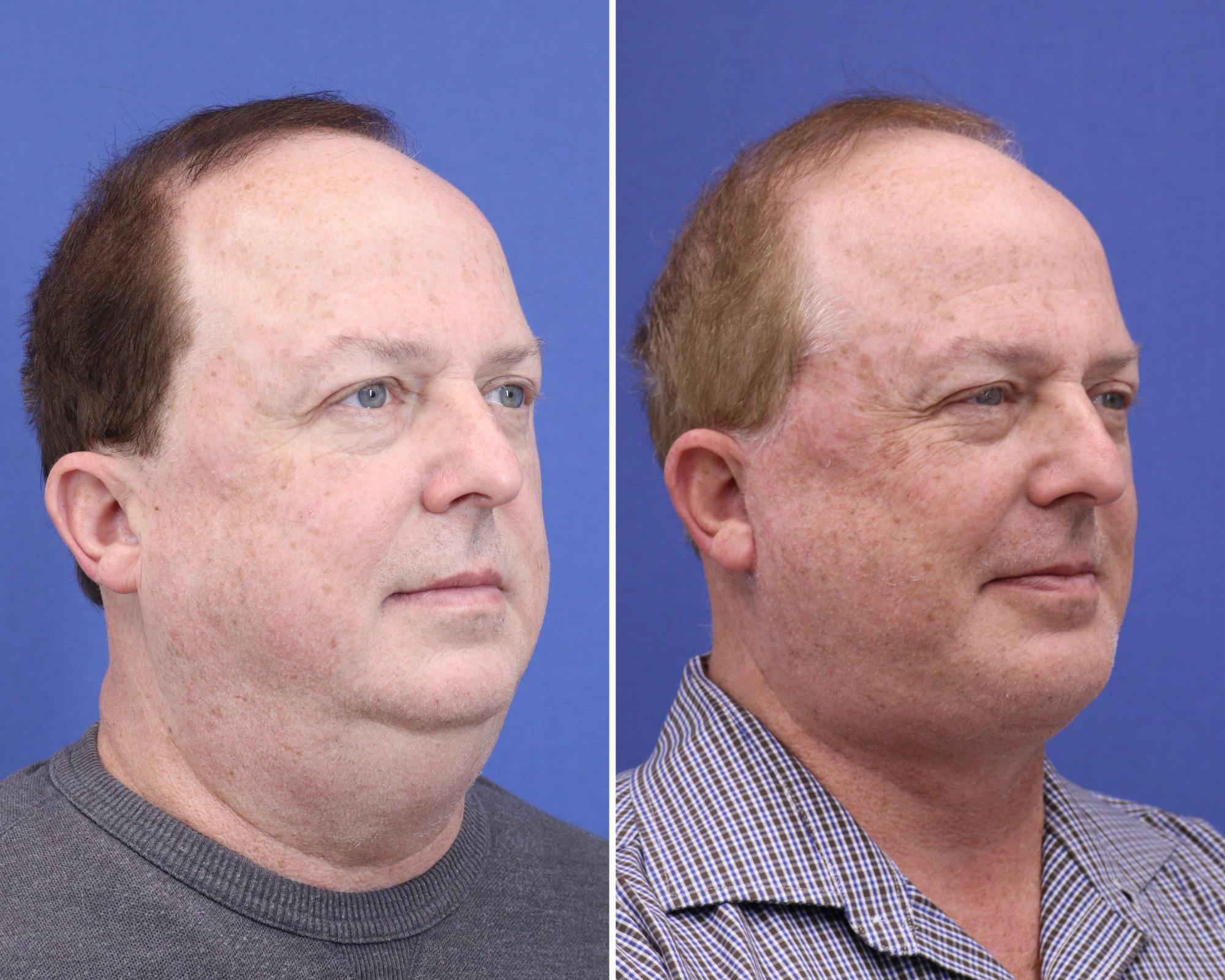 Chin Implants Before & After Gallery - Patient 243631 - Image 2
