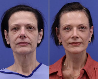 Temple Lift Before & After Gallery - Patient 156468 - Image 1