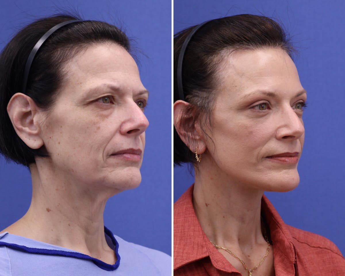 Blepharoplasty Before & After Gallery - Patient 635185 - Image 2
