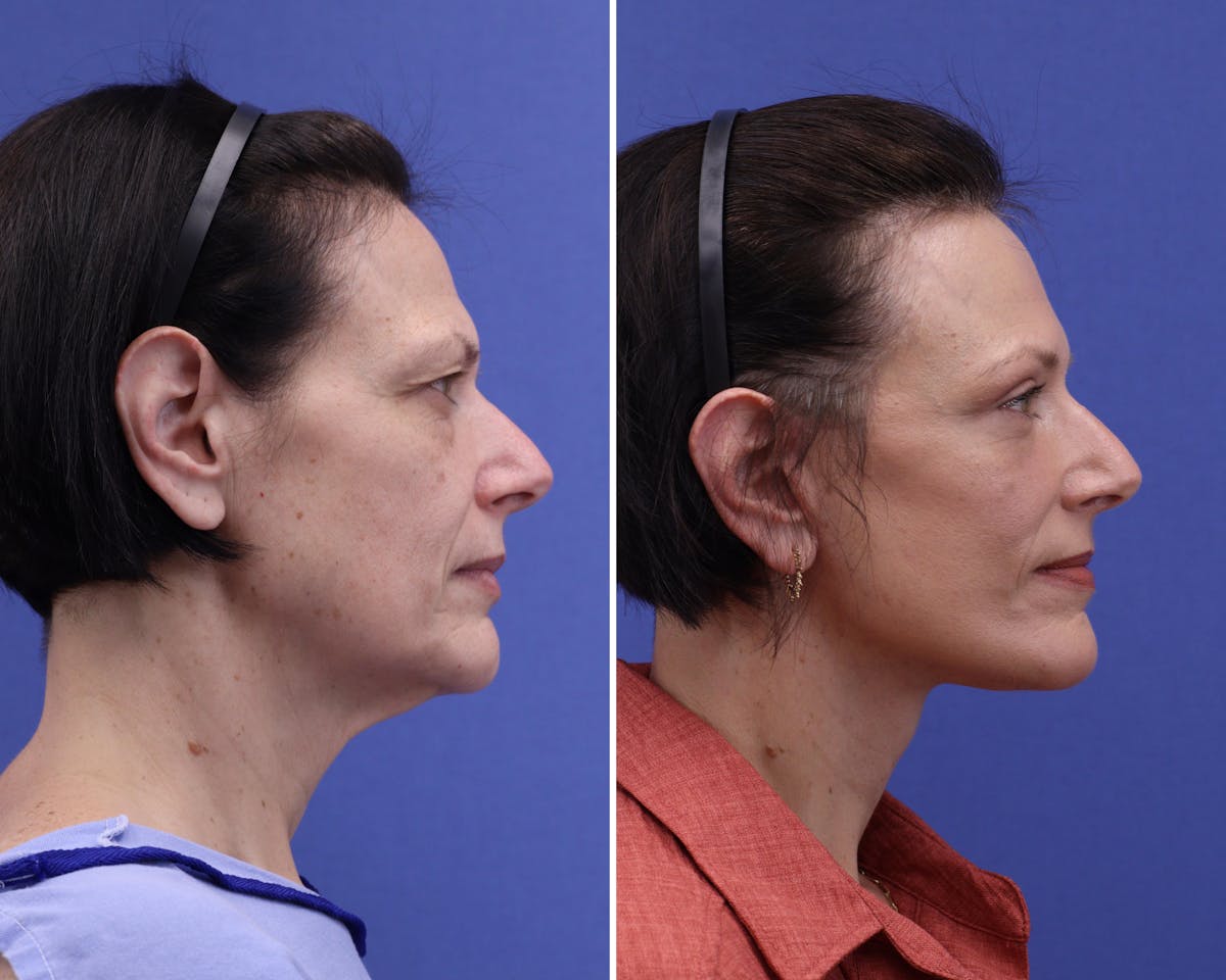 Blepharoplasty Before & After Gallery - Patient 635185 - Image 3