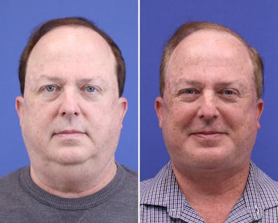 Neck Lift Before & After Gallery - Patient 427213 - Image 1