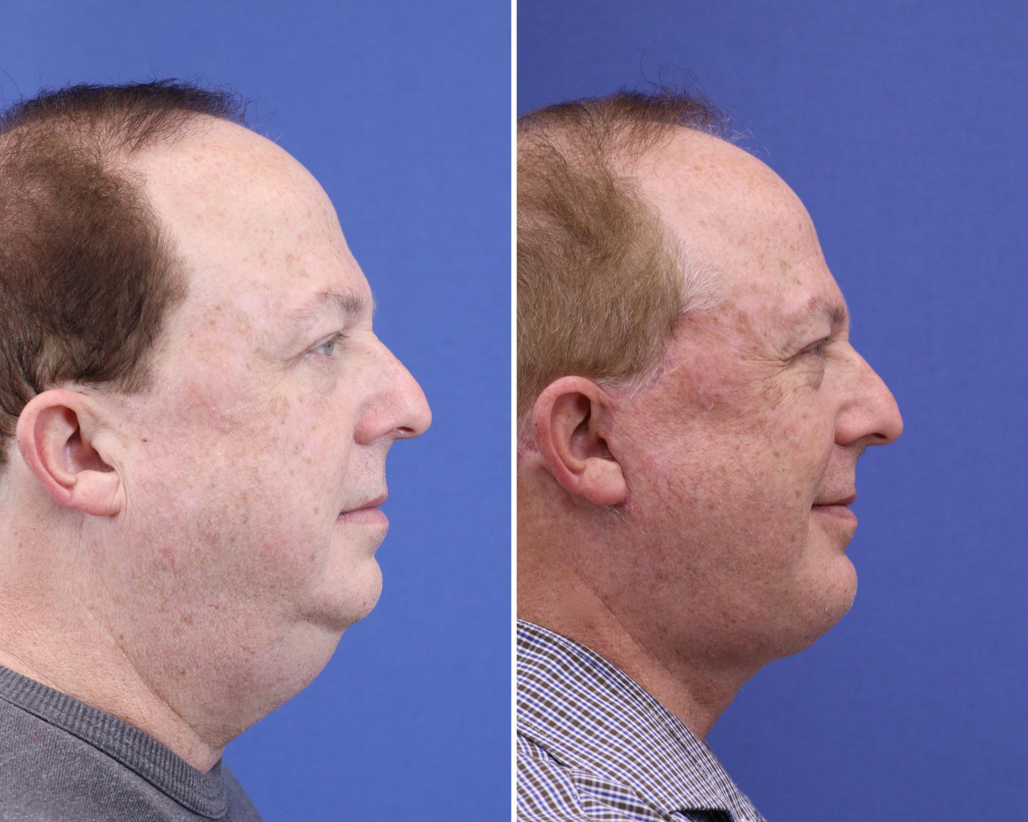 Chin Implants Before & After Gallery - Patient 243631 - Image 3