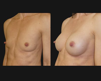 Breast Before & After Gallery - Patient 917933 - Image 1