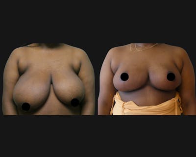 Breast Before & After Gallery - Patient 241464 - Image 1