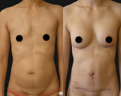 Mommy Makeover Before & After Gallery - Patient 965025 - Image 1