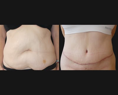 Tummy Tuck Before & After Gallery - Patient 300778 - Image 1
