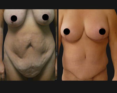 Breast Before & After Gallery - Patient 355974 - Image 1