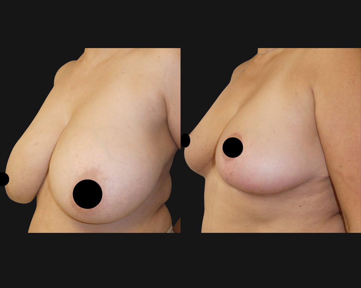 Breast Before & After Gallery - Patient 744798 - Image 1