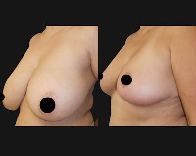 Breast Before & After Gallery - Patient 744798 - Image 1