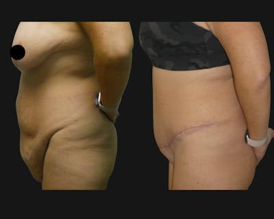 Mommy Makeover Before & After Gallery - Patient 125057 - Image 1