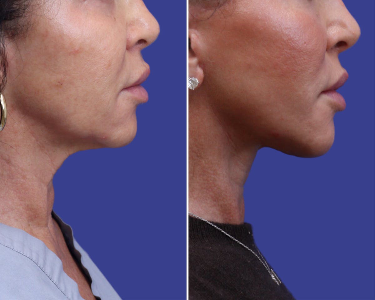 Neck Before & After Gallery - Patient 260238 - Image 1