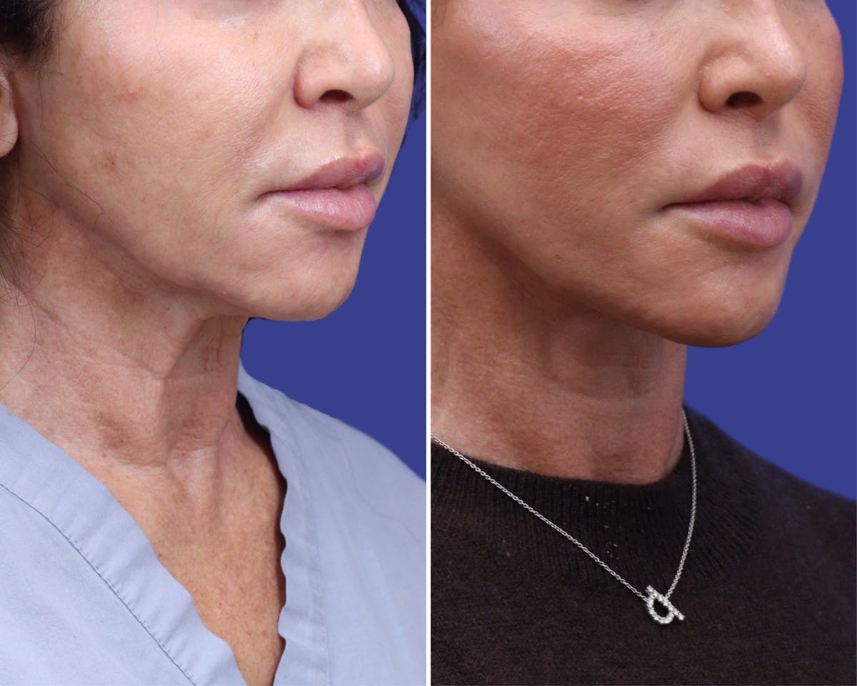 Neck Before & After Gallery - Patient 260238 - Image 2