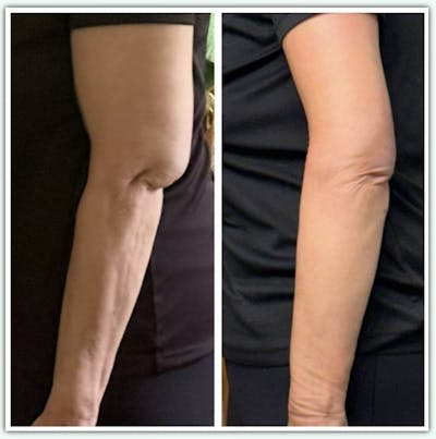Arm Lift Before & After Gallery - Patient 181221 - Image 1