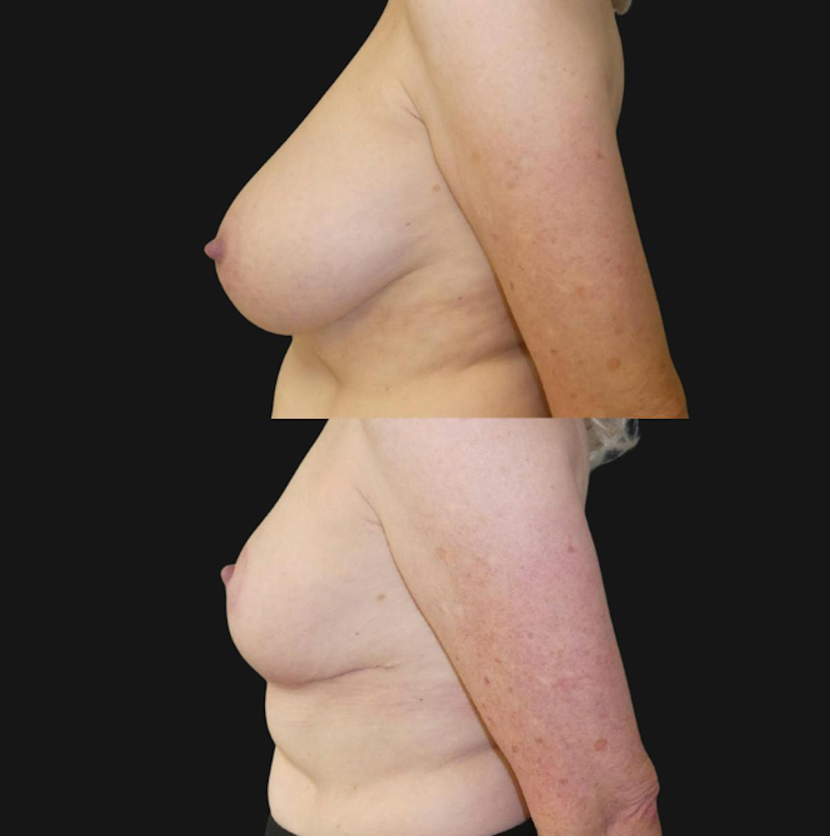 Breast Reduction Before & After Gallery - Patient 391174 - Image 2