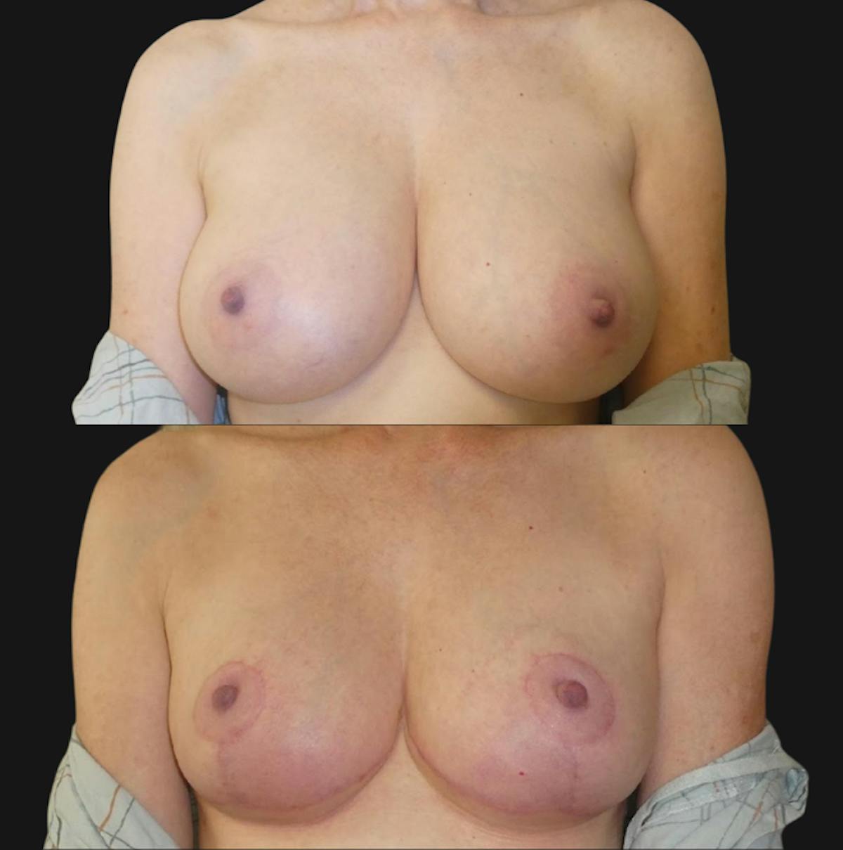 Breast Reduction Before & After Gallery - Patient 391174 - Image 1