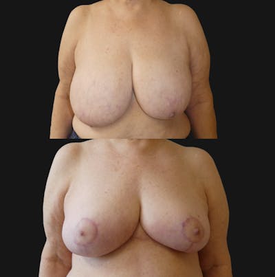 Breast Reduction Before & After Gallery - Patient 557277 - Image 1