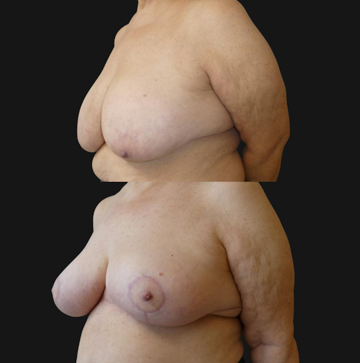 Breast Reduction Before & After Gallery - Patient 557277 - Image 3
