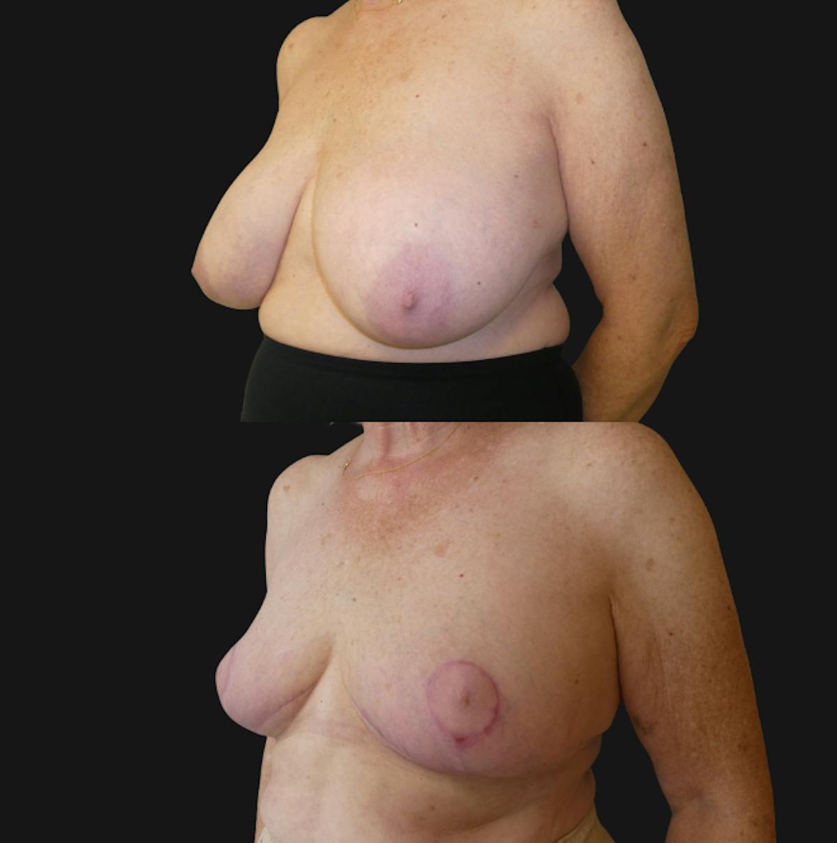 Breast Reduction Before & After Gallery - Patient 362387 - Image 2
