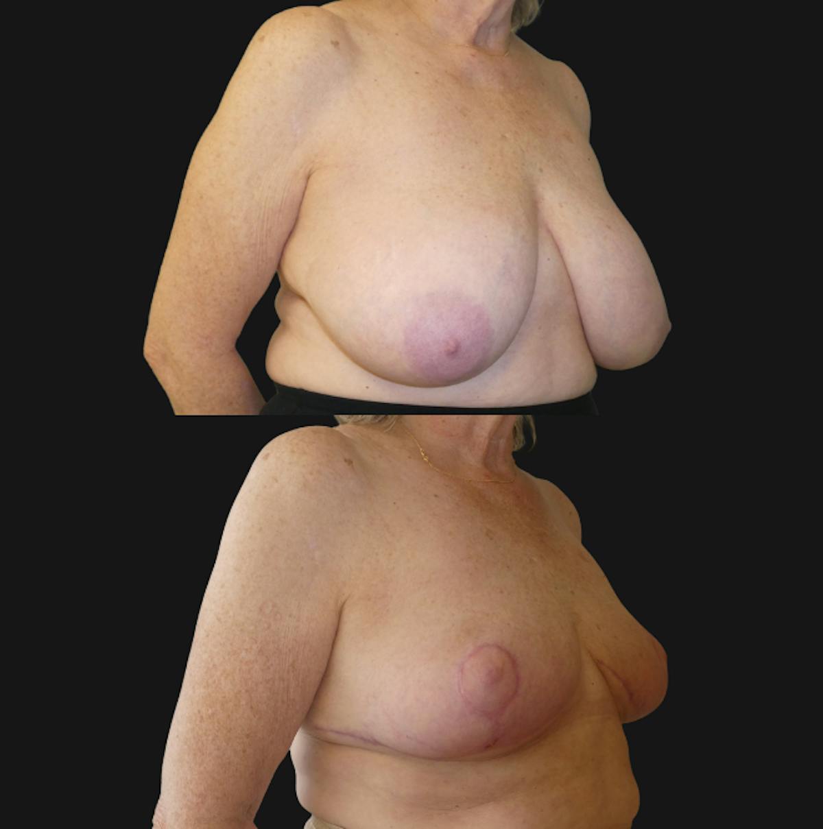 Breast Reduction Before & After Gallery - Patient 362387 - Image 4