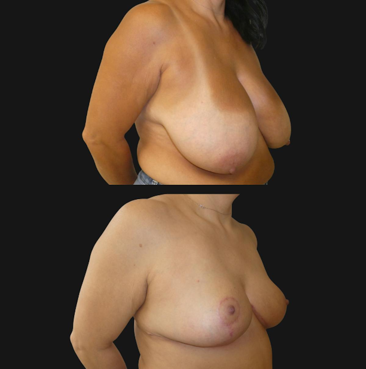 Breast Reduction Before & After Gallery - Patient 359490 - Image 2