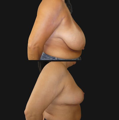 Breast Reduction Before & After Gallery - Patient 359490 - Image 1