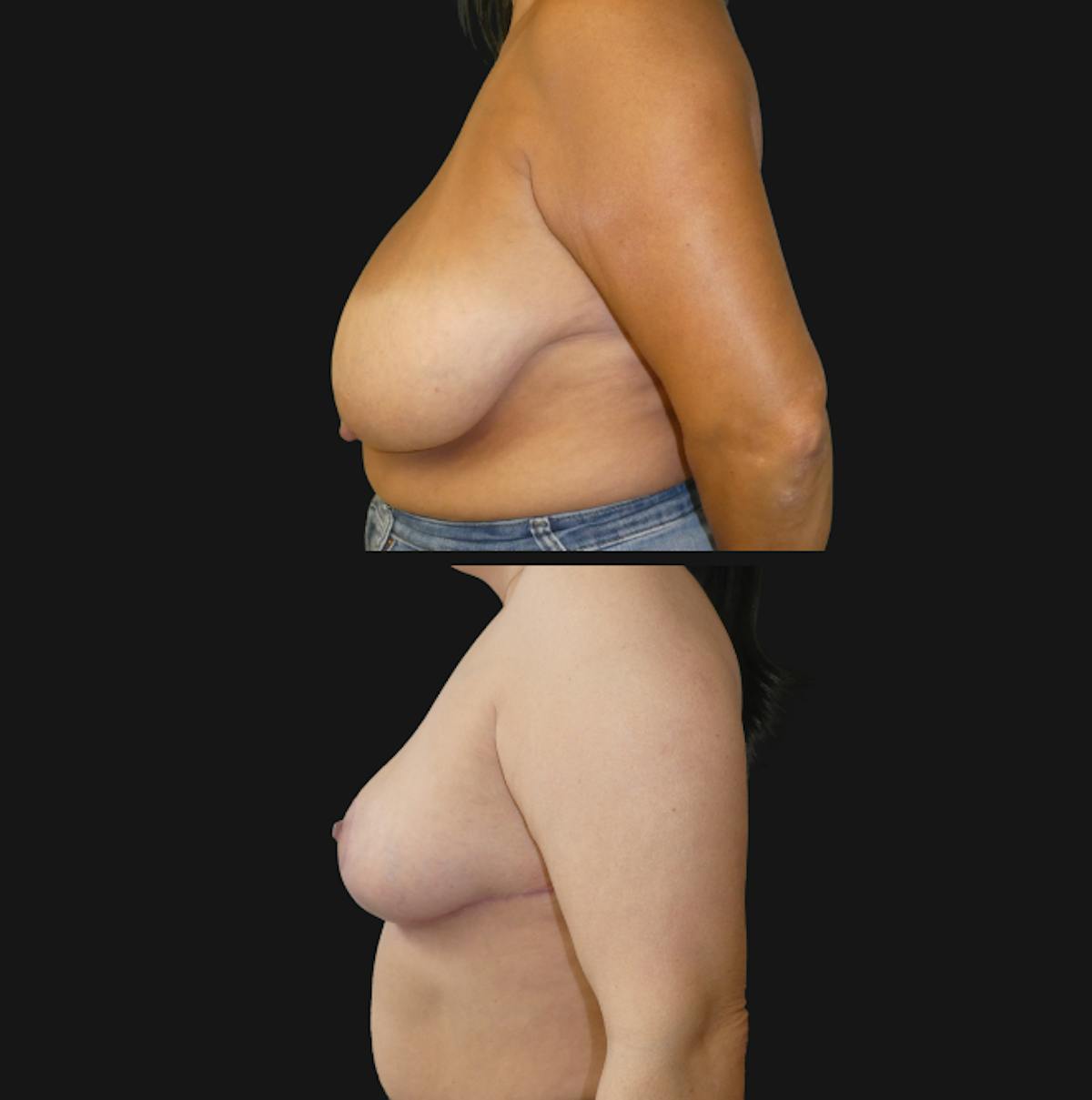 Breast Reduction Before & After Gallery - Patient 359490 - Image 3