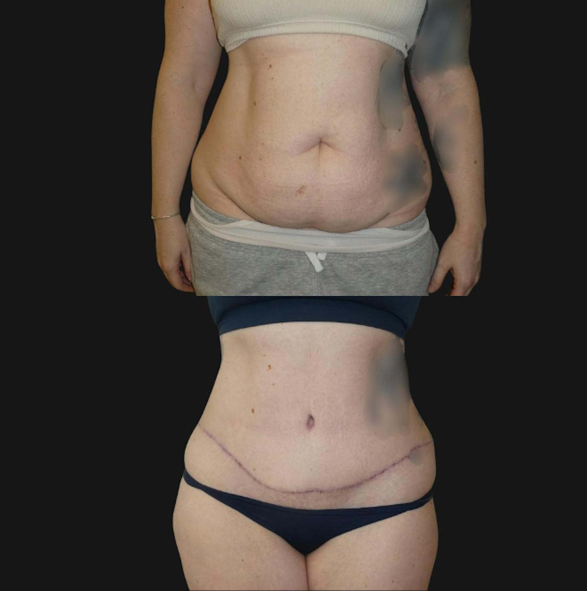 Tummy Tuck / Abdominoplasty Before & After Gallery - Patient 563352 - Image 1