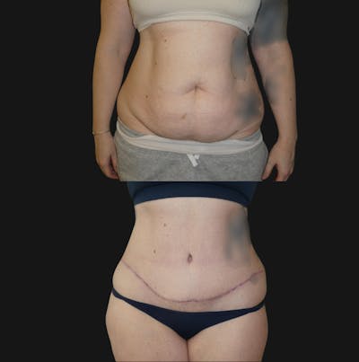 Tummy Tuck / Abdominoplasty Before & After Gallery - Patient 563352 - Image 1