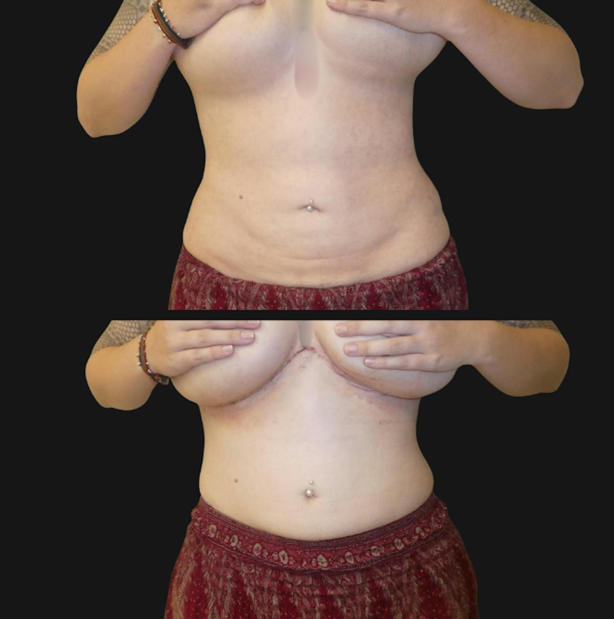 Tummy Tuck / Abdominoplasty Before & After Gallery - Patient 158832 - Image 1