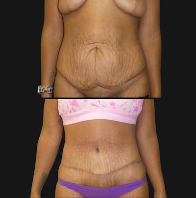 Tummy Tuck / Abdominoplasty Before & After Gallery - Patient 463627 - Image 1